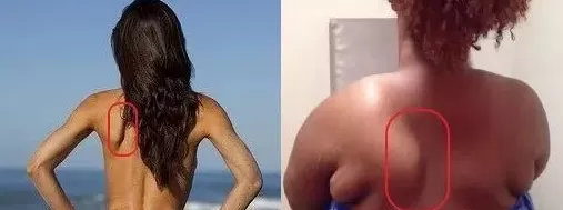 这样的“蝴蝶骨”很美？不用羡慕，得治-第1张图片-