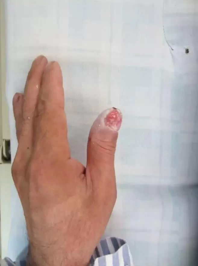 女子散步误踩氢氟酸身亡!致命“化骨水”竟可网购,烧伤救治专家发声-第3张图片- 女子散步误踩氢氟酸身亡!致命“化骨水”竟可网购,烧伤救治专家发声-第3张图片-