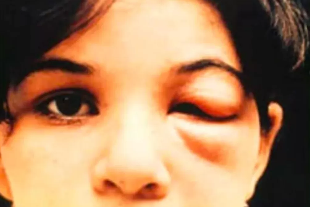 超一亿人处于危险之中,它被称为新的艾滋病-第2张图片- 超一亿人处于危险之中,它被称为新的艾滋病-第2张图片-