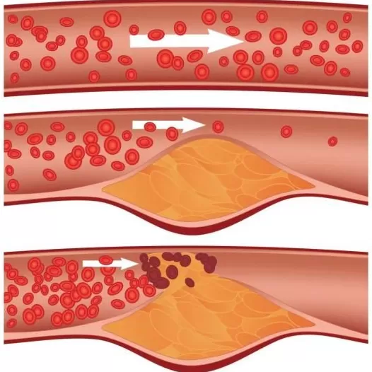 这种东西顿顿离不开,吃多了却容易一身病-第9张图片- 这种东西顿顿离不开,吃多了却容易一身病-第9张图片-