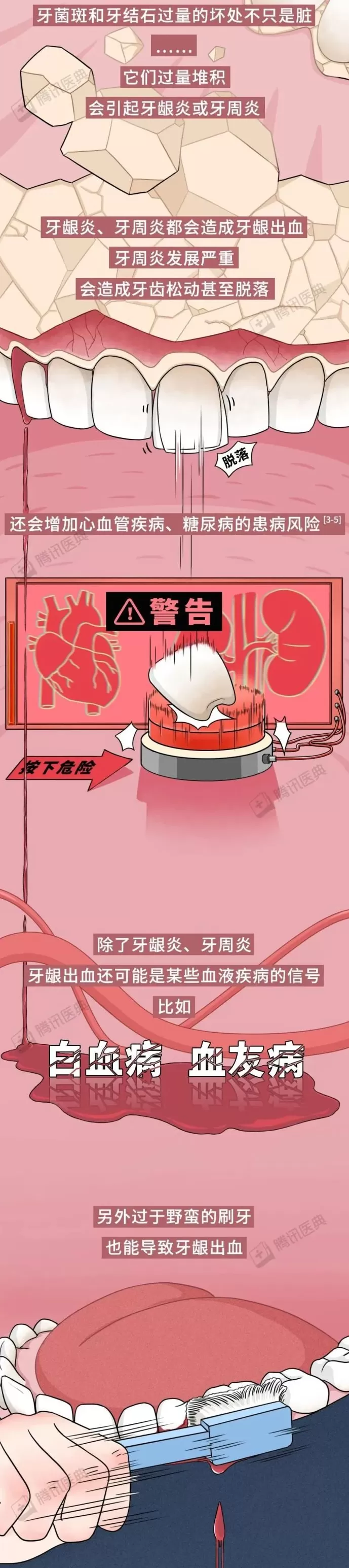 一刷牙就出血，身体到底发生了什么？-第5张图片-