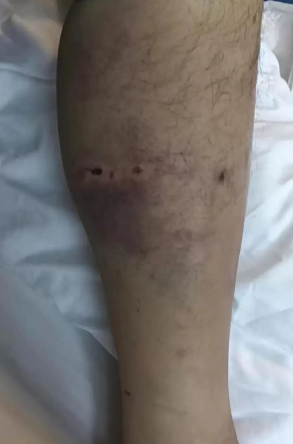 重庆男子上山采菌被黑熊袭击，“被一巴掌扇下悬崖，穿的水鞋救了自己一命”-第3张图片-