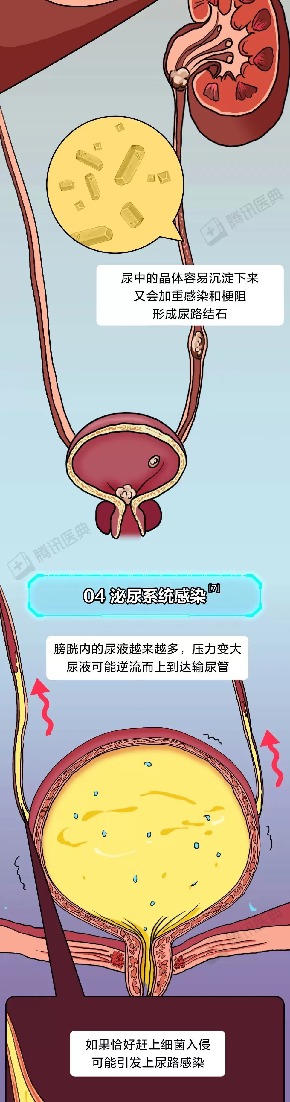 膀胱最怕的这件事，你可能每天都在做-第11张图片-