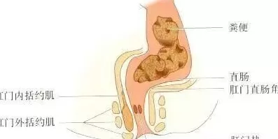 82岁老人用筷子通便把直肠壁捅破，医生提醒-第1张图片-