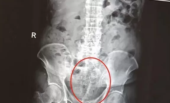 82岁老人用筷子通便把直肠壁捅破，医生提醒-第2张图片-