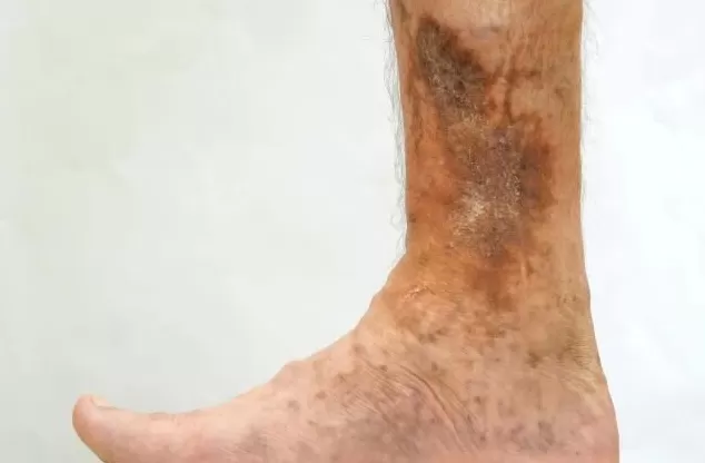 腿上出现“小蚯蚓”，别不当回事，可能被这种病盯上了-第7张图片-