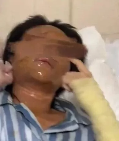 女主播被伪装包裹炸伤，当事人：面部深二度烧伤，眼睛肿得只有一条缝-第2张图片-