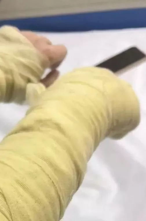 女主播被伪装包裹炸伤，当事人：面部深二度烧伤，眼睛肿得只有一条缝-第1张图片-