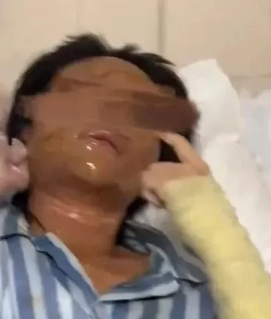 女主播称遭“炸弹包裹”袭击，面部及手臂严重炸伤！警方通报：刘某强，刑拘-第4张图片-