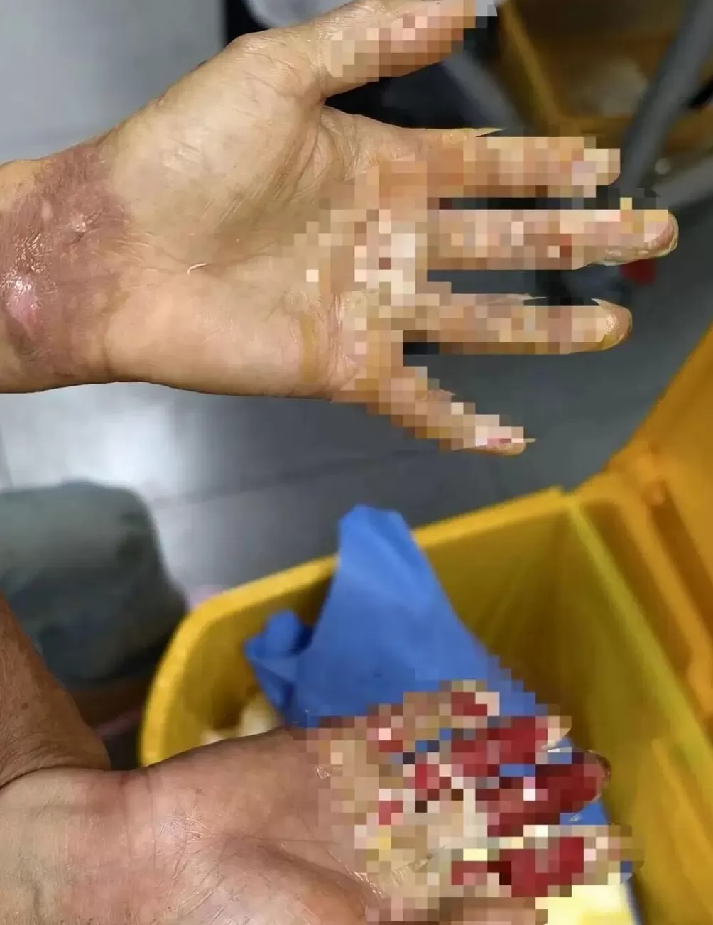 3岁男童不慎掉进炭火堆，全身85%烧伤，母亲徒手救出-第3张图片-