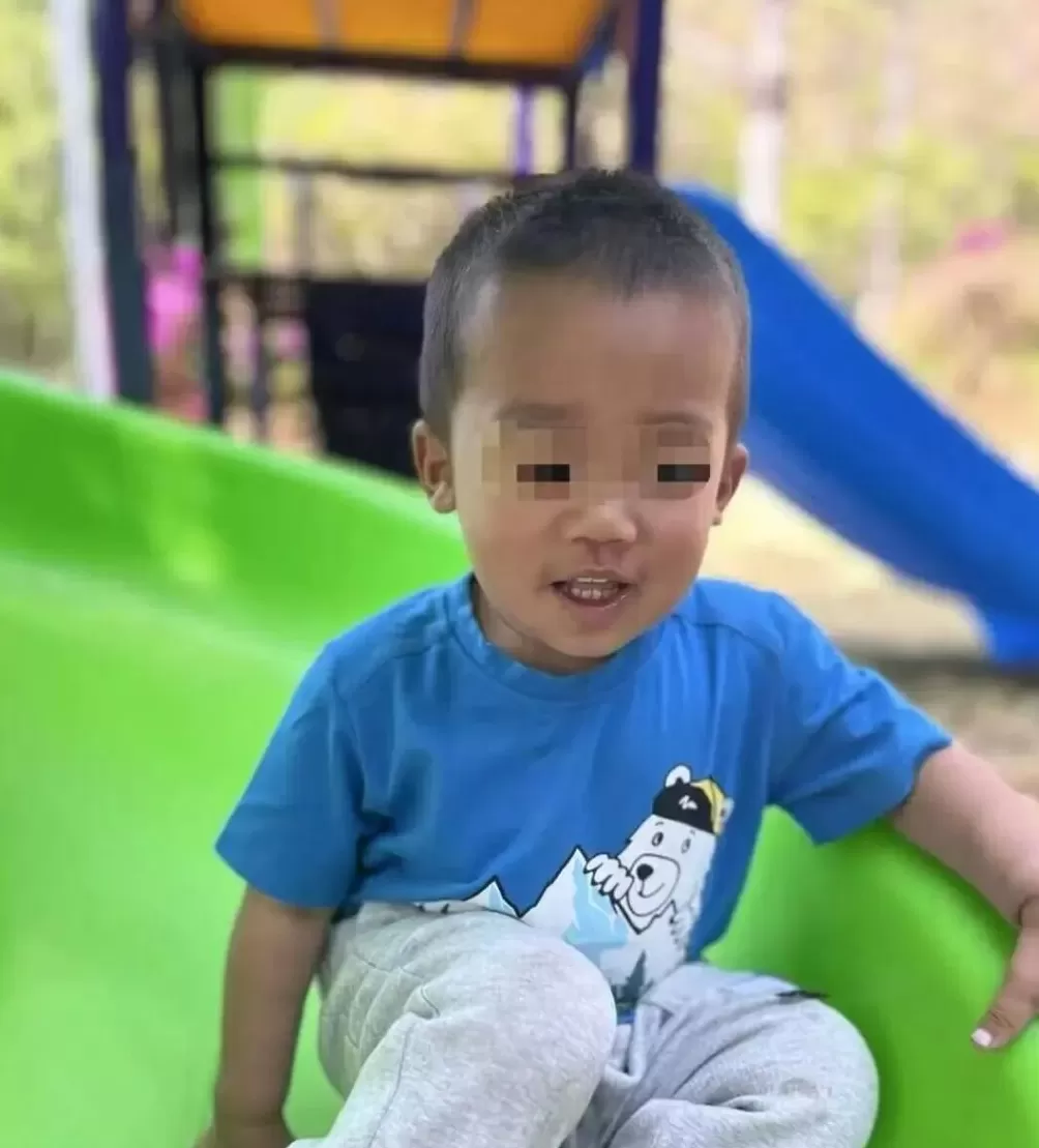 3岁男童不慎掉进炭火堆，全身85%烧伤，母亲徒手救出-第5张图片-