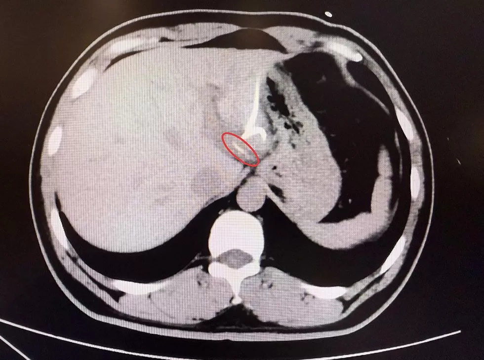 男子误吞鱼刺险切肝，上海医生内镜下取出肝中鱼刺创造“全球首例”-第1张图片-