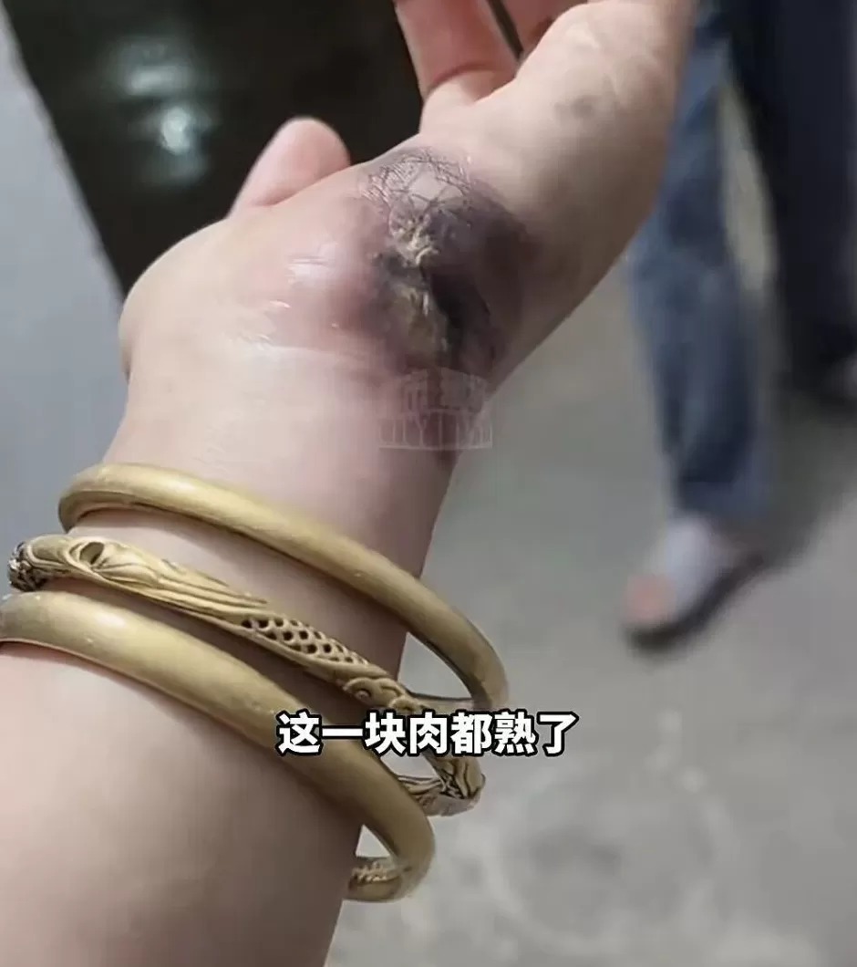 手被烧熟、金手镯被烧熔，女子给电动车充电，不慎碰到充电口受伤-第2张图片-