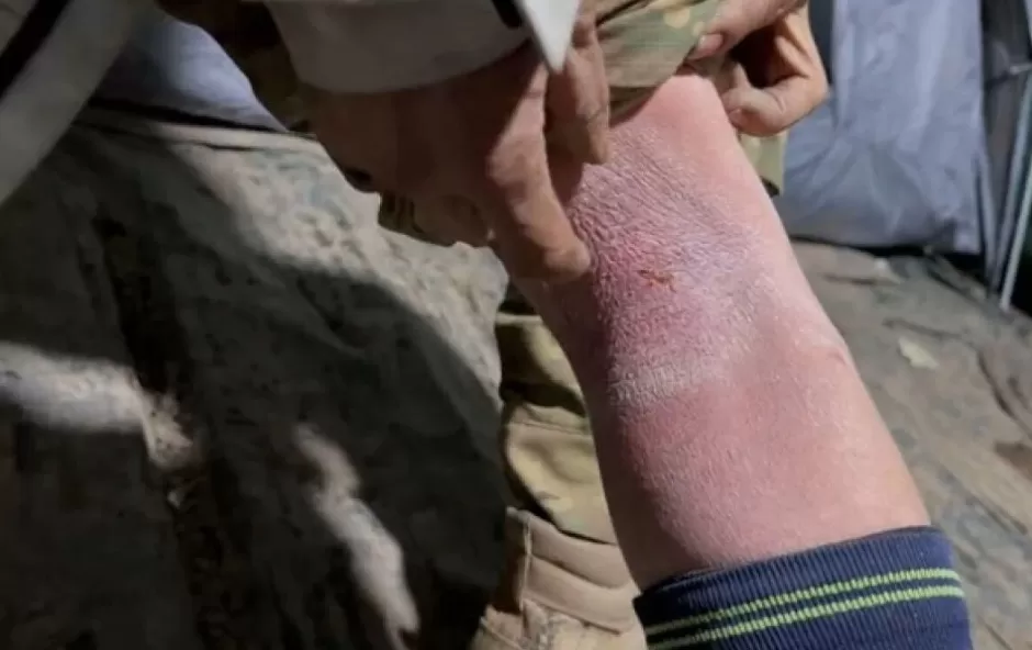 张家界荒野求生热门选手退赛，连下一周雨致腿部冻伤，本人发声：缺盐影响冻伤愈合-第3张图片-