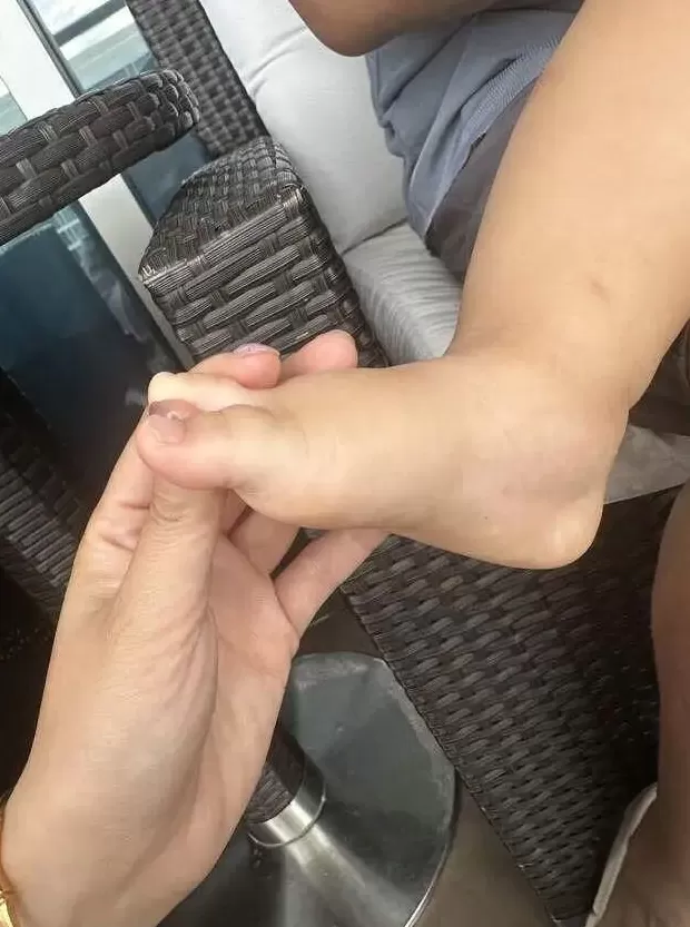 婆孙在泳池边被毒虫咬伤，酒店称虫子是从外面飞进来的，跟酒店没关系！多方最新回应-第2张图片-