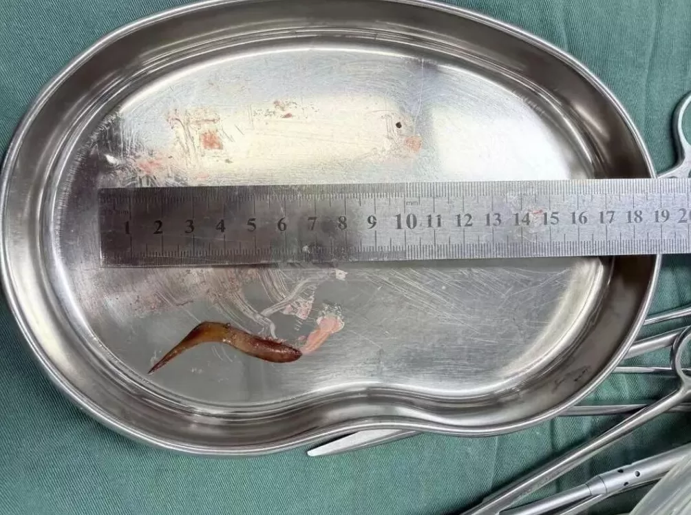 男子甲鱼骨卡喉吞饭“自救”致腹腔感染医生紧急提醒-第1张图片-