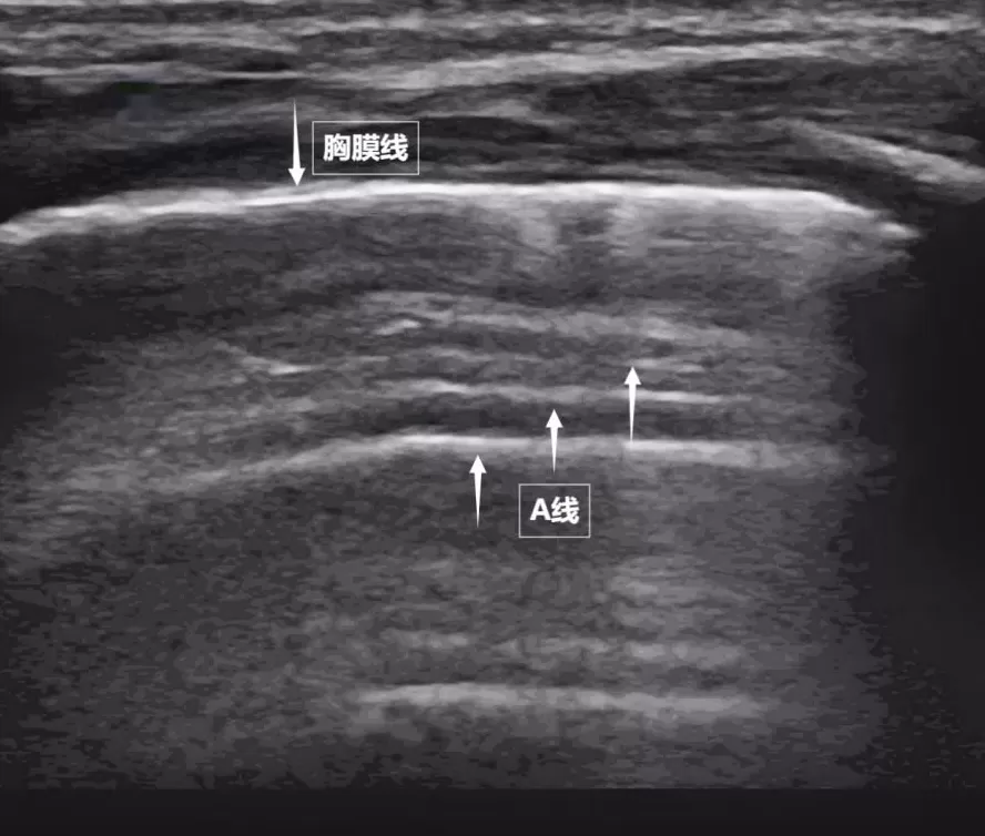 无声的声波有形的肺-第2张图片-