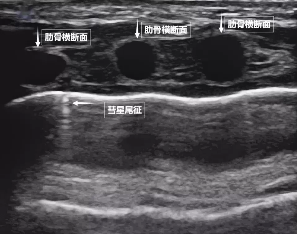 无声的声波有形的肺-第3张图片-