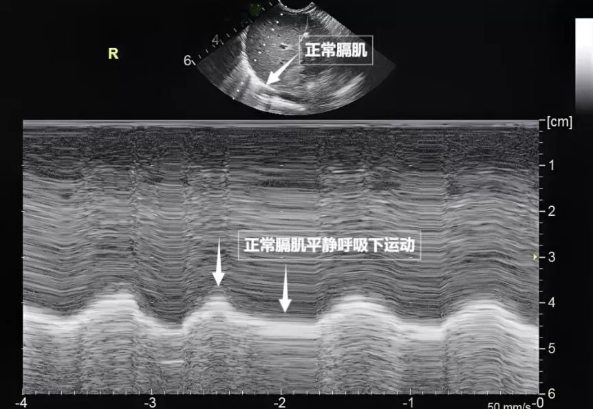 无声的声波有形的肺-第4张图片-