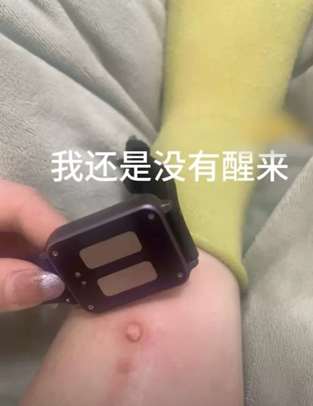 手环“电击续命”，有人已被烧伤-第6张图片-