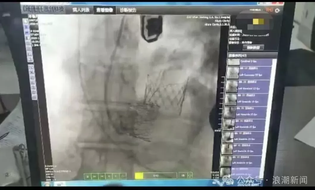 西安交大一附院再曝“瓣膜谜团”：出厂价3万多，医院收28万-第2张图片-