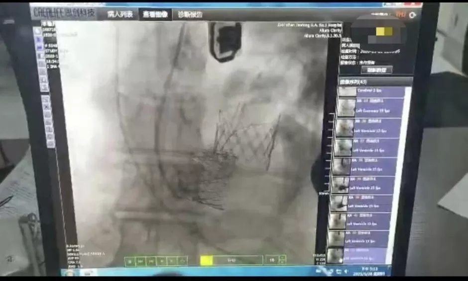 一个心脏瓣膜出厂价3万多，医院收取患者28万？西安交大一附院医疗事件再曝“瓣膜谜团”-第2张图片-