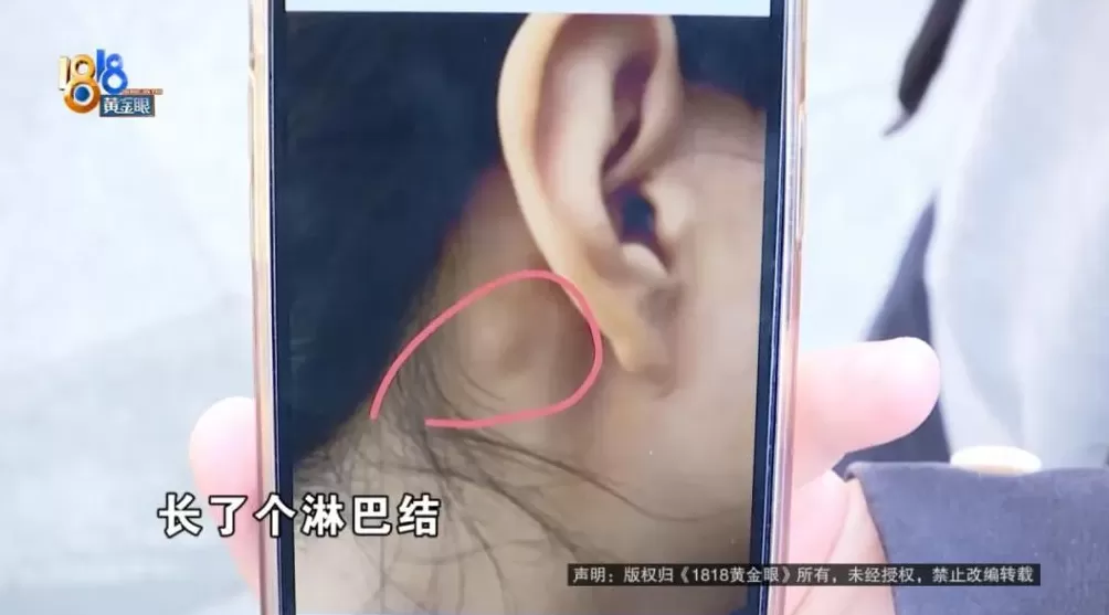 理完发第三天，女子从耳朵里掏出一团棉花-第7张图片-