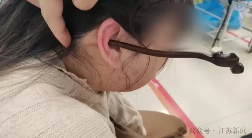 女子睡前“偷懒”没摘发饰，夜里插入耳朵直抵后脑勺！医生：并非个例-第2张图片-